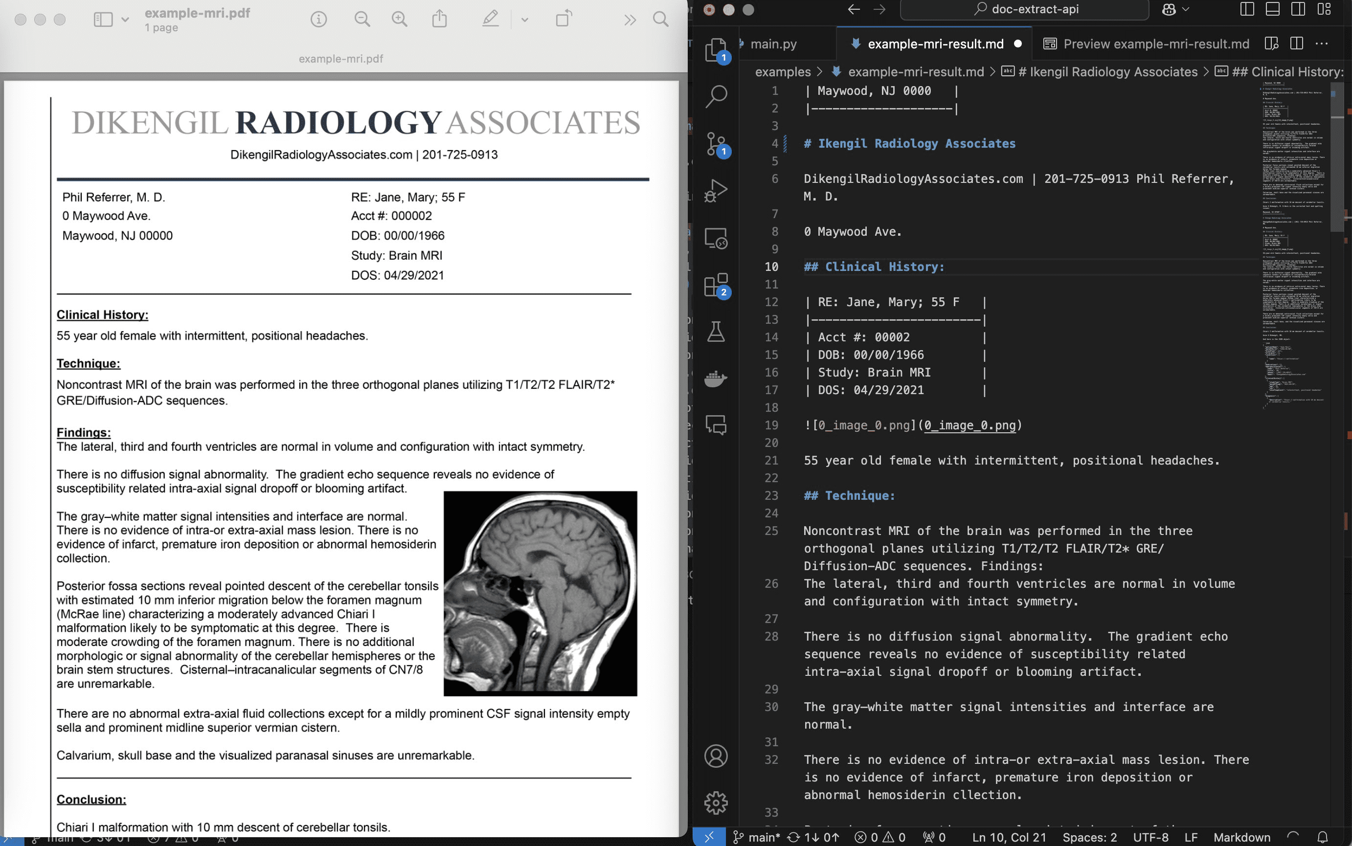 pdf-extract-api：PDF文档或图片转换JSON/Markdown，自动抹去个人信息-1